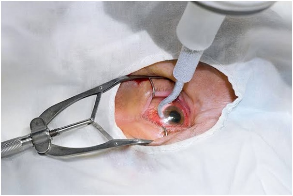 Retina eye surgery at delhi eye care
