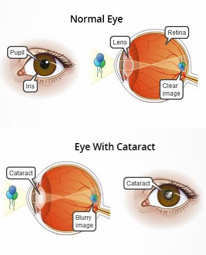 normal eye vs cataract eyes