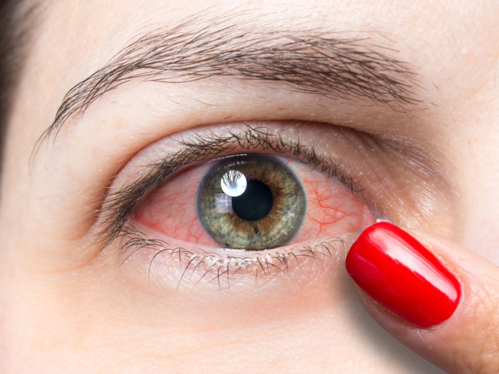 Conjunctivitis or Pink Eye – Causes, Symptoms and Prevention