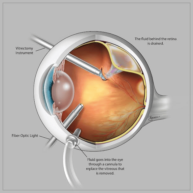 Retinal Vitrectomy