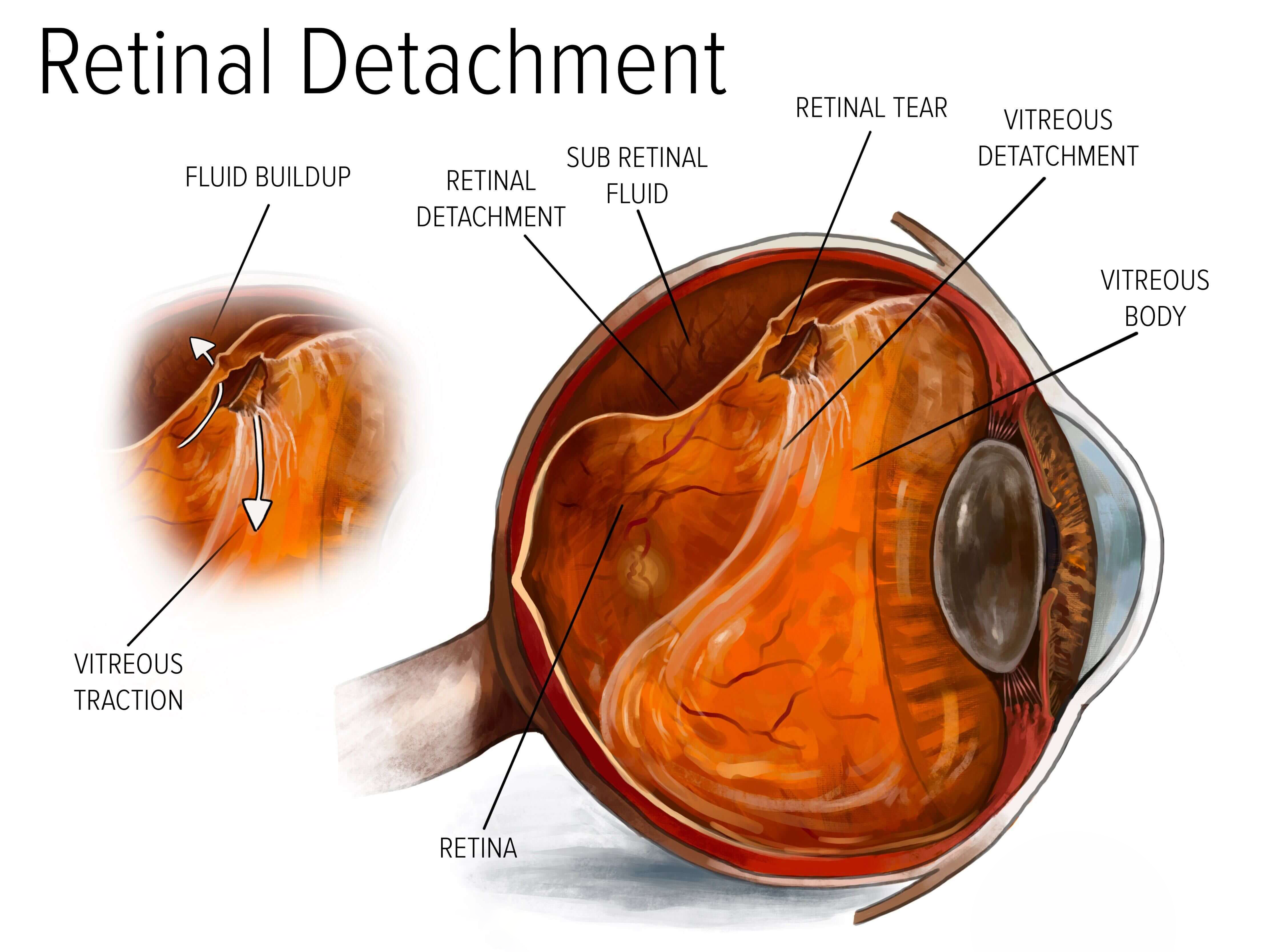 Retinal Detachment Surgery in Delhi, India, Treatment Cost & Best Results